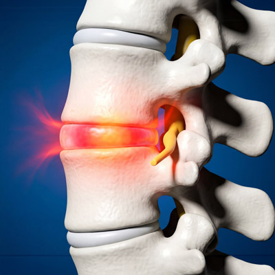 can a herniated disc heal naturally