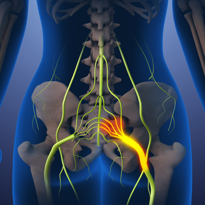 can sciatica go away on its own